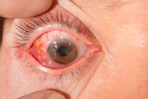 Sklerit nedeniyle sklerada belirgin kızarıklık ve hiperemi görülen göz görüntüsü