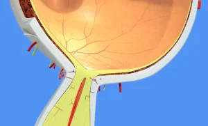 Wolfram sendromunda optik sinir atrofisini gösteren şematik optik sinir görseli