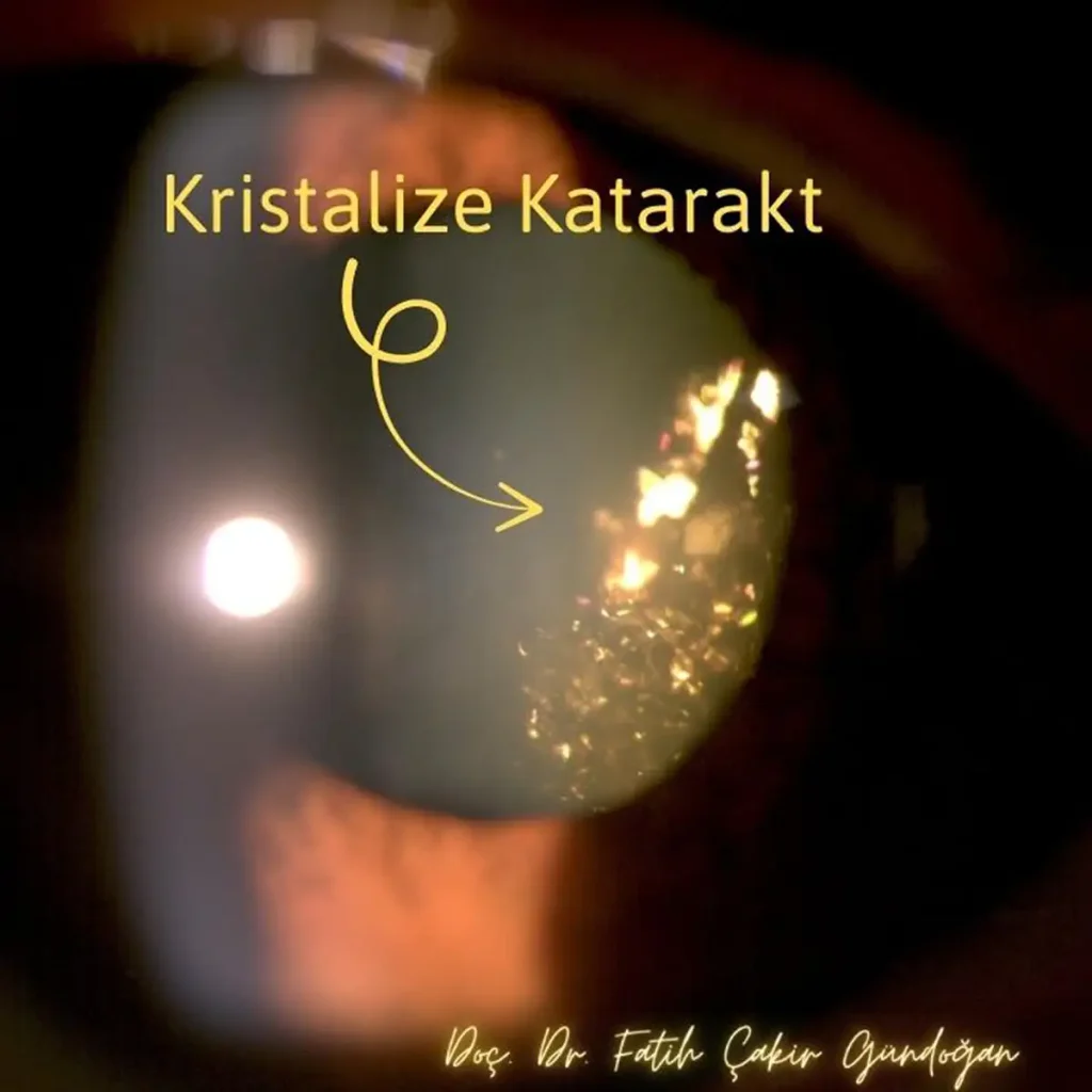 Kristal şeklinde katarakt görünümü bulunan göz merceği görüntüsü