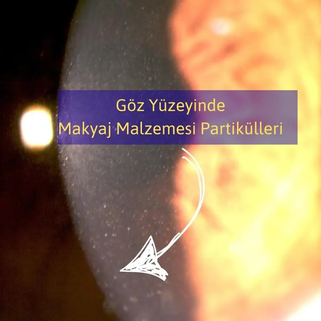 Göz yüzeyinde makyaj partikülleri ve yabancı madde kalıntıları