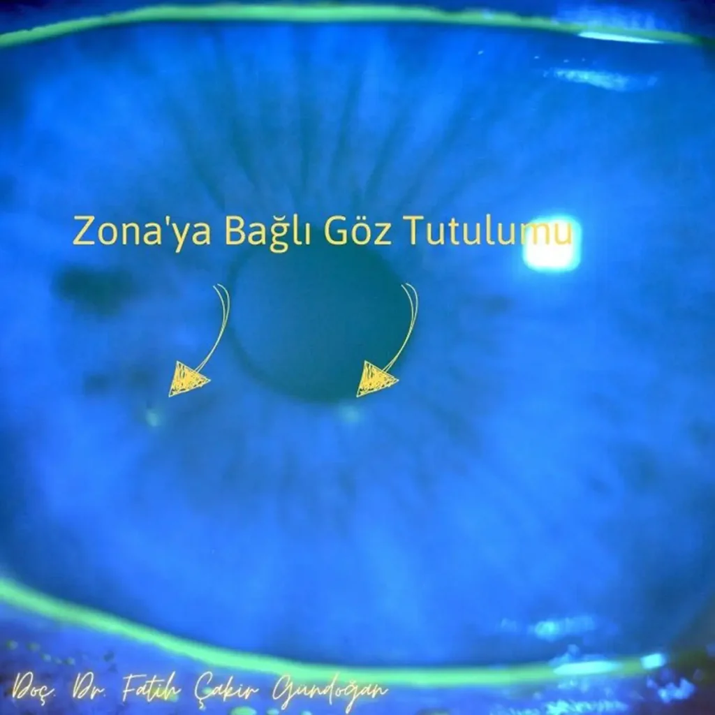 Herpetik keratit bulunan gözde kornea enfeksiyonu görünümü