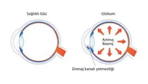 Sağlıklı göz ve glokomlu göz karşılaştırması; göz içi basıncı artışı nedeniyle optik sinir