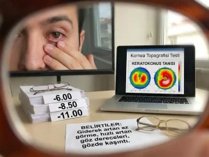 Keratokonus belirtilerini gösteren görsel: korneada hafif öne bombeleşme, bulanık görme, ışık saçılması/halo ve göz kaşıma temsili