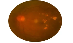 Diyabetik retinopati hastasında retina ödemi, sert eksudalar, yumuşak eksudalar ve intravitreal kanama görülen göz dibi fotoğrafı
