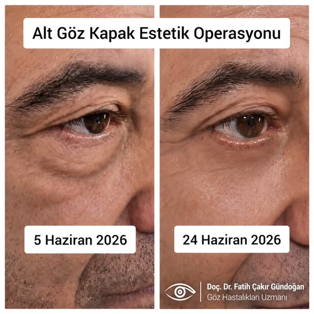 Alt göz kapağı estetik operasyonu önce ve sonra: göz altı torbasının giderilmesi