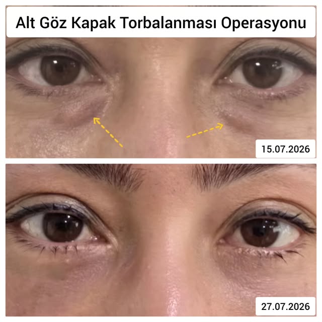 Alt göz kapağı torbalanması operasyonu önce ve sonra: her iki alt göz kapağındaki torbalanmanın giderilmesi