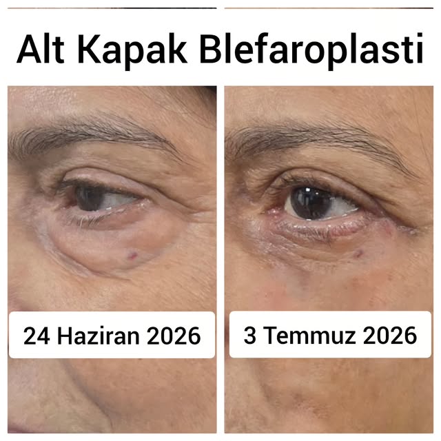 Alt kapak blefaroplasti önce ve sonra: göz altı torbalanmasının azaltılması